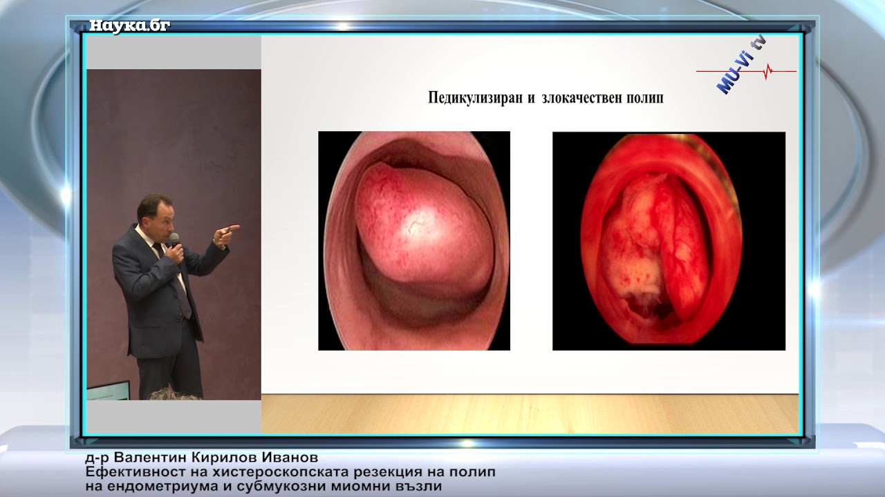 Ефективност на хистероскопската резекция на полип на ендометриума и субмукозни миомни възли