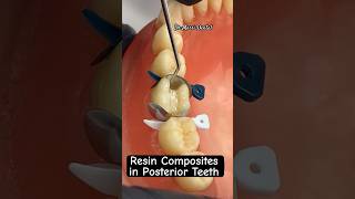 Resin Composites in Posterior Teeth