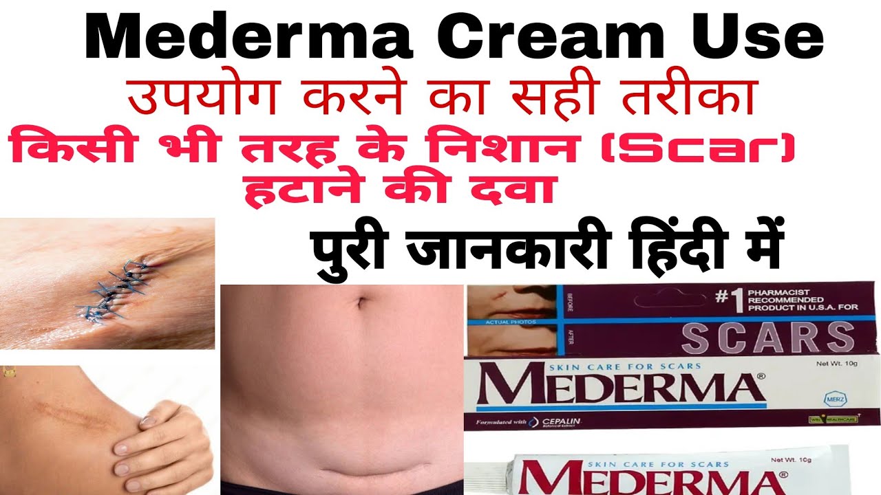 Mederma Cream Mederma For Cut Marks and Scars Acne Mederma Advance