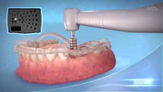 Dental Tutorial - MGUIDE by MIS (3D Medical Animation)