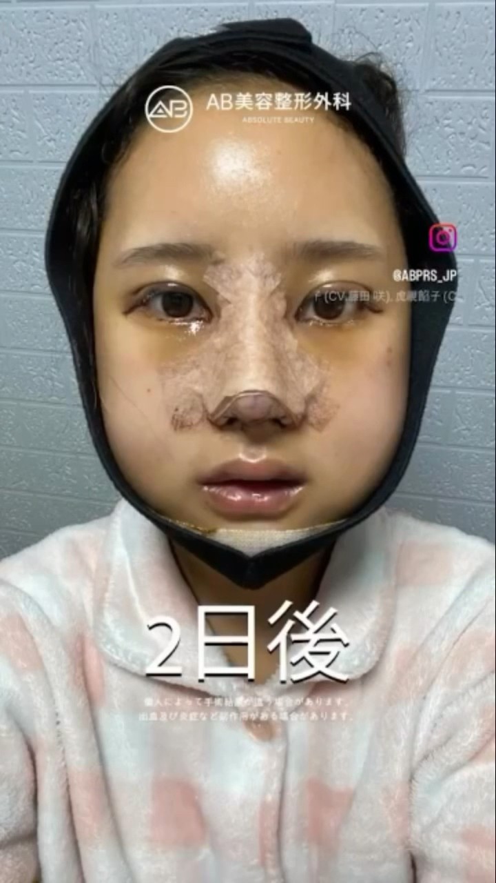 [韓国整形] 顔面輪郭整形 + 目の再手術 + 鼻整形 #ab美容整形外科
