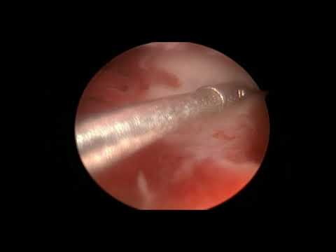 Endoscopic Management of Complete Vaginal & Uterine Septum - Dr Pankaj Mate