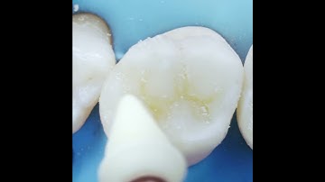 Class II Solution Finishing&Polishing | Dentsply Sirona