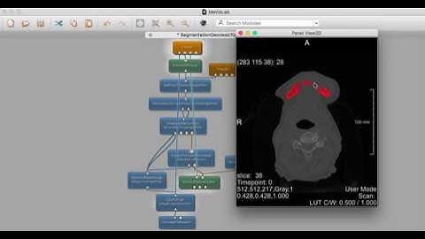 MeVisLab Geodesic ACM Level Set Image Filter Tutorial Video for Mandibular/Lower Jawbone Extraction