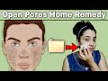 Open Pores के लिए घरेलू उपचार - हमेशा के लिए हो जायेंगे रोम छिद्र बंद - Home remedies for open pores