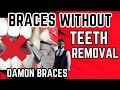 Damon Braces/NO TEETH REMOVAL/Braces without teeth removal/Braces without taking teeth out