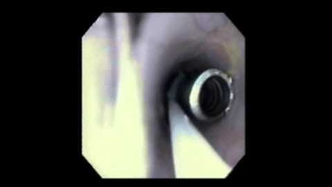 ROTH NET™ Retriever - Various Foreign Body Retrieval