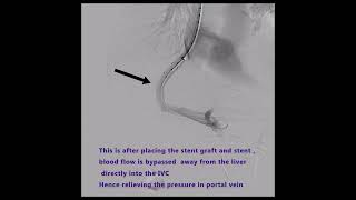 Transjugular Intrahepatic Portosystemic Shunt