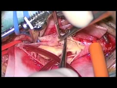 頚動脈内膜剥離（はくり）術