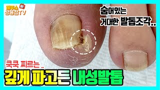 깊게 파고든발톱#fungus #ingrown_toenail #thicktoenailtreatment