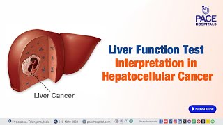 Liver Function Test Interpretation in Hepatocellular Cancer | #liverfunctiontest