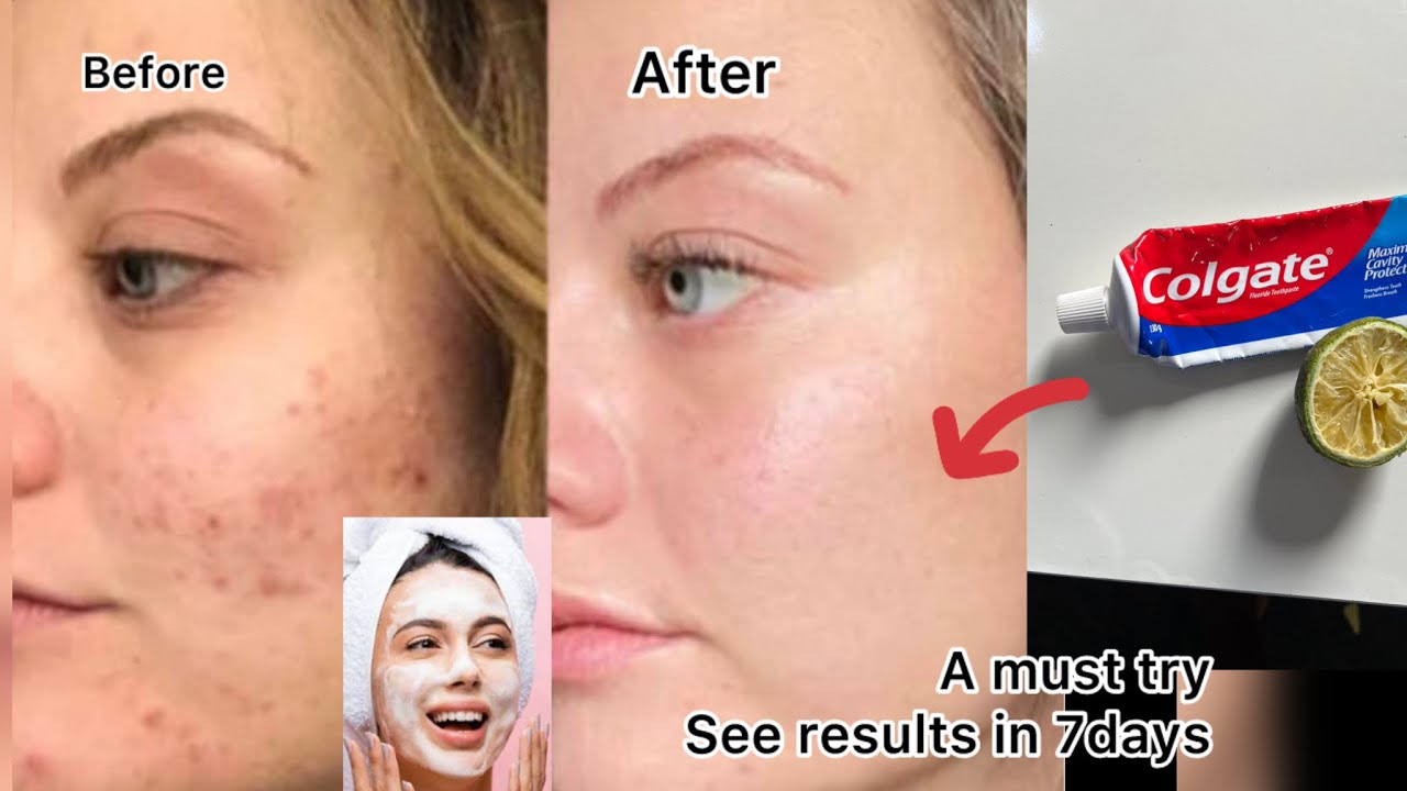 Use Colgate toothpaste for face whitening/Get a clear whitening face with just Colgate & lemon