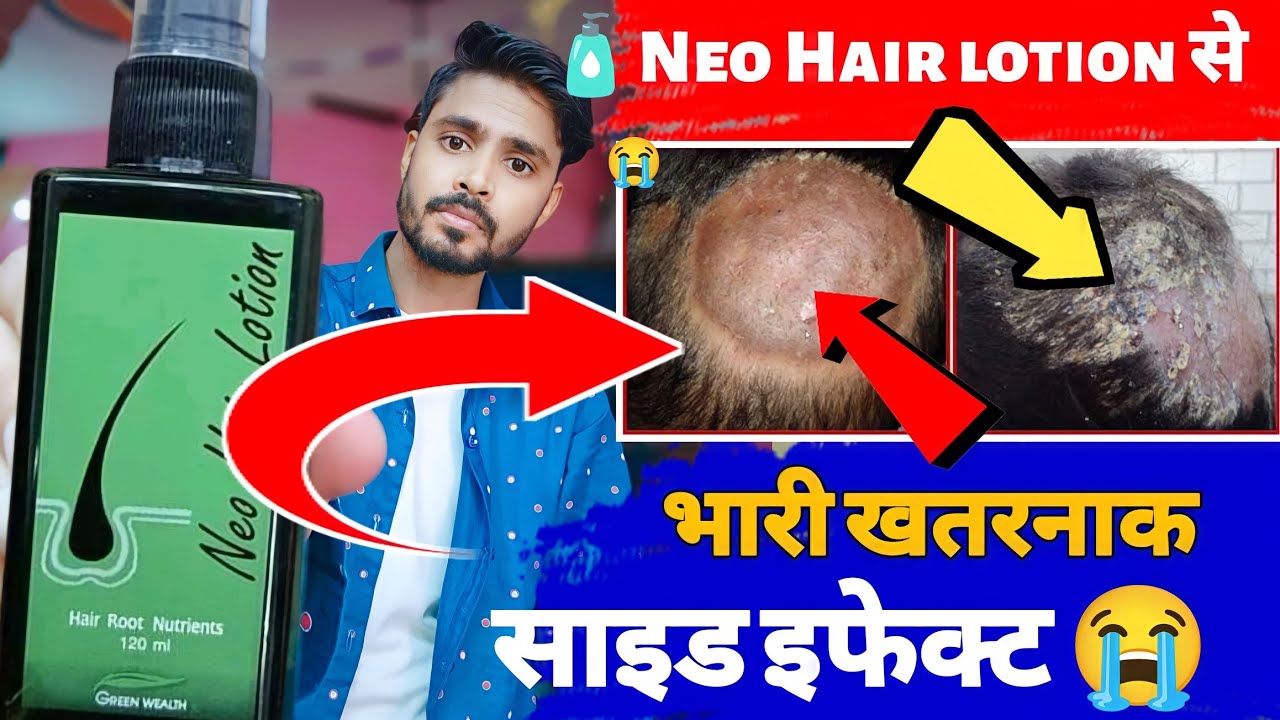 Neo Hair lotion Side effects neo hair lotion original and fake Hair