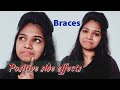 🦷പല്ലിൽ കമ്പിയിട്ടാൽ മെലിയുമോ? | Positive Side Effects Of Braces