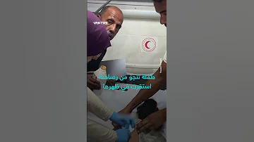 طفلة تنجو من رصاصة استقرت في ظهرها 