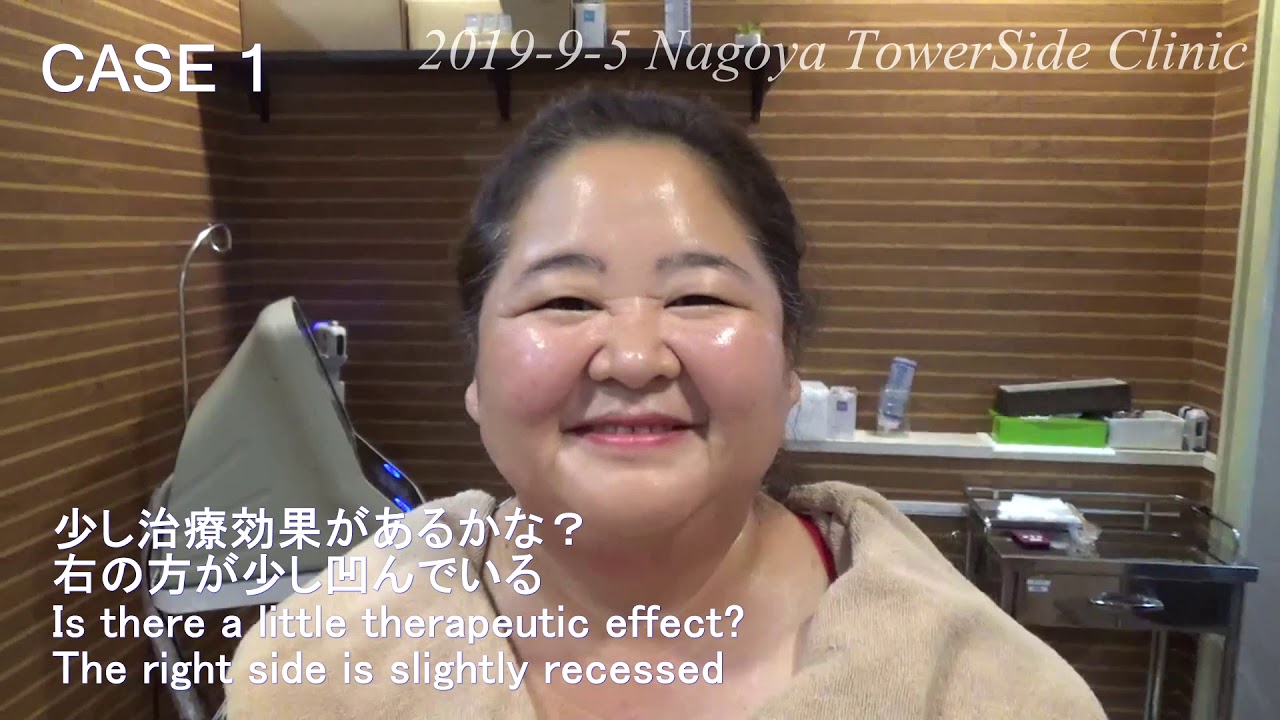 首の若返り ダブロによる Neck Rejuvenation By Doublo Youtube