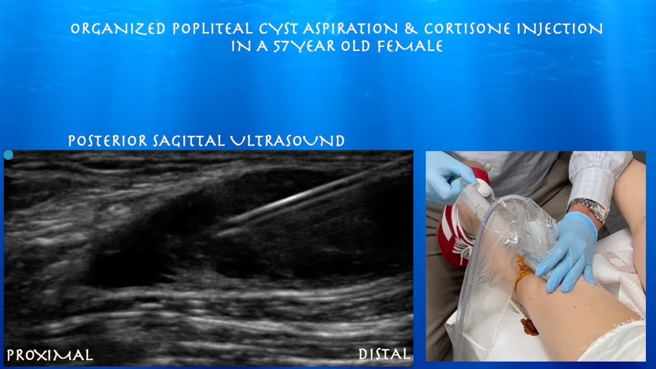 Popliteus Injection Ultrasound Guided Complex Popliteal Cyst Aspiration and Cortisone ...