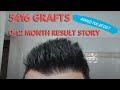 ASMED-Koray Erdoğan(0-12 months) Hair Transplant Result 5146 grafts FUE