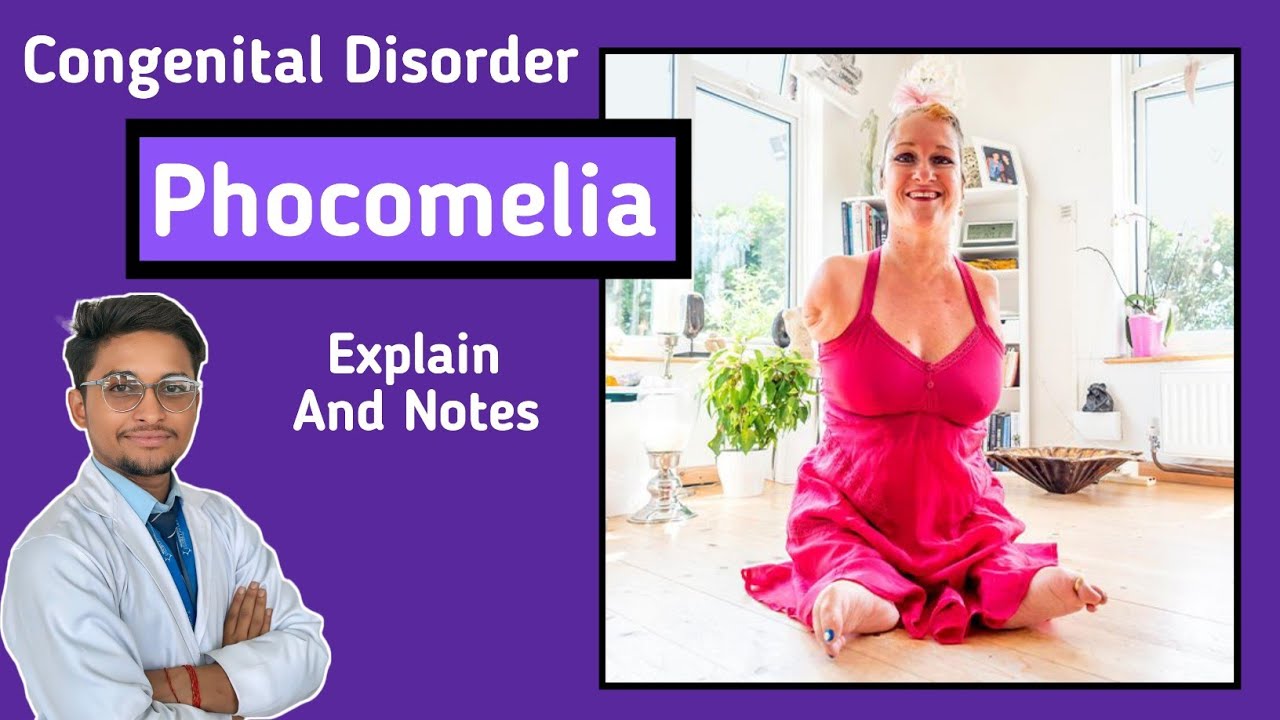 Phocomelia Congenital Disorder Orthopaedics YouTube phocomelia-congenital-disorder-orthopaedics-youtube