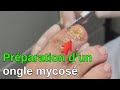 Mycose  prparation de longle par le pdicurepodologue