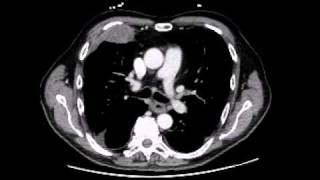 Mesothelioma