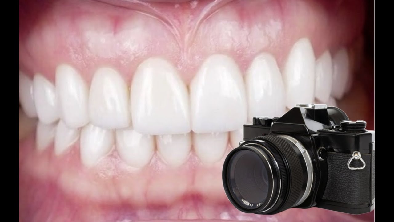 Behind the Lens What Porcelain Veneers Before and After Pictures Won't