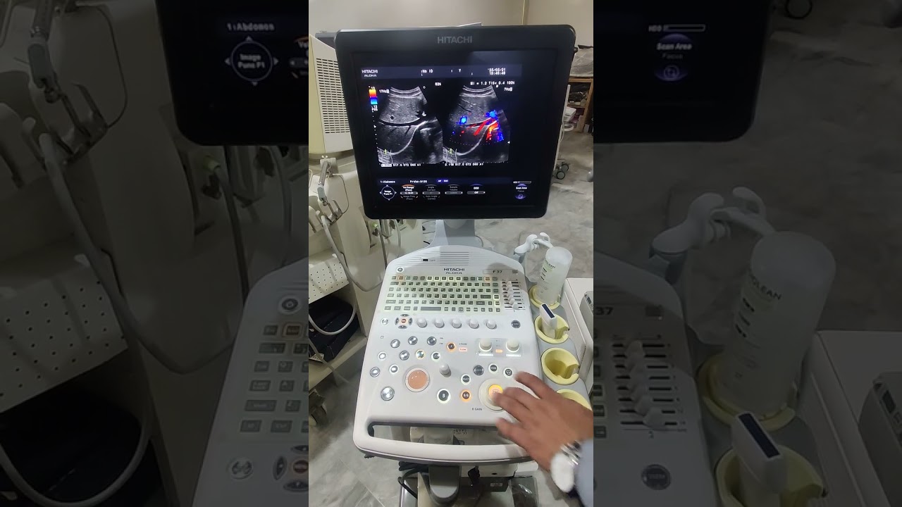 Hitachi Aloka Ultrasound machine review