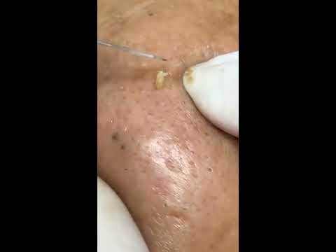 Acne Removal