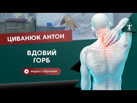 Правда о том, откуда появляется вдовий горб. Циванюк Антон