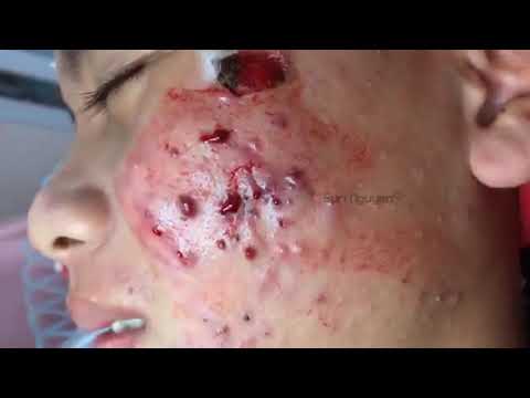 Inflamed Cystic Acne Removal  pop squeeze remove