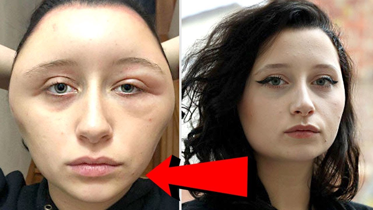 Woman's Head Doubles In Size After Allergic Reaction To Hair Dye - YouTube