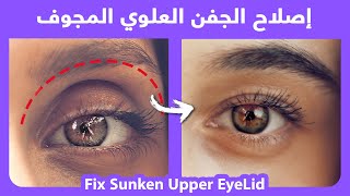 Sunken Eyes | Naturally Fix Sunken Upper Eyelids |  كيفية إصلاح الجفن العلوي الغائر بطريقة طبيعية