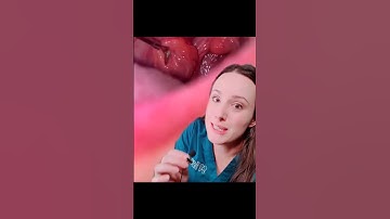 Tonsil stone removal: dentist reacts 🤢