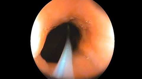 Endoscopic removal of coin with help of Roth Net under GA