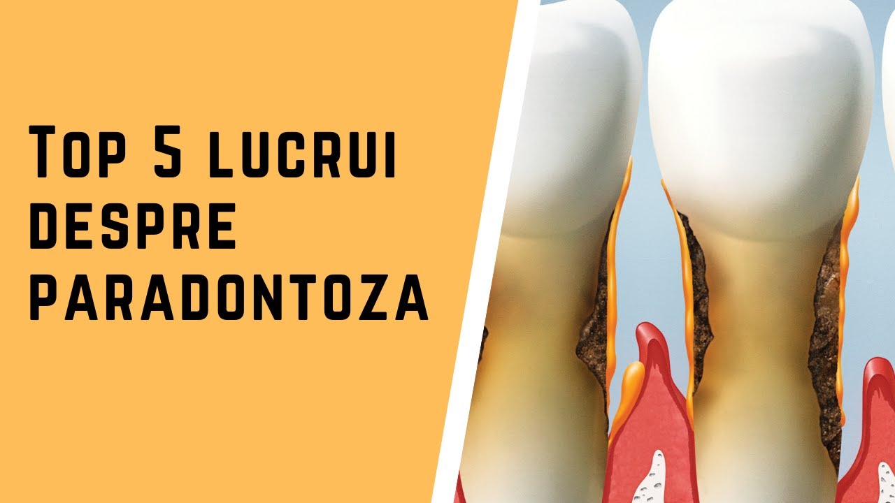 Top 5 lucruri despre boala parodontala / paradontoza