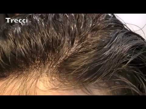 protesi capelli e sudore