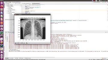 AI Coronavirus Detection|  +91-9872993883 for query| Tensorflow Hindi | Deep Learning|