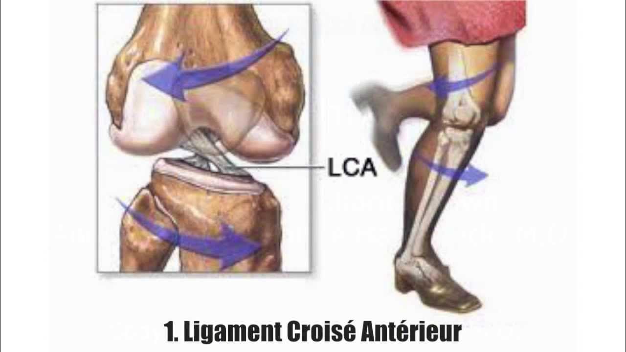 разволокнение крестообразные связки коленного сустава