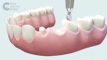 Dental bridge treatment animation - English