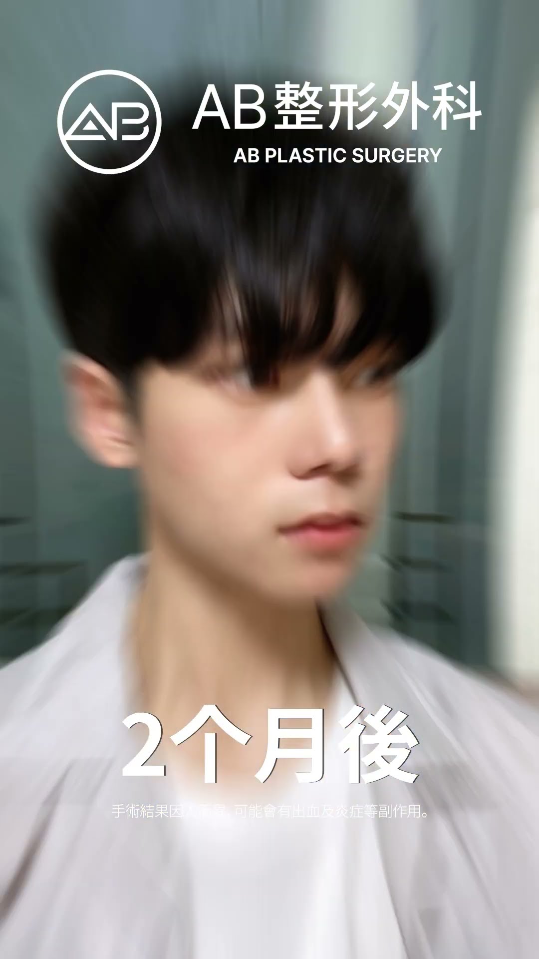 帥氣重生：鼻子與輪廓整形的完美蛻變 #热门 #推荐