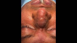 Hemangioma Rhinoplasty