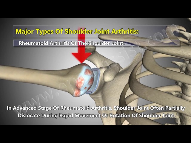 Impinged shoulder rheumatoid arthritis