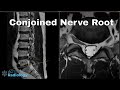 How To Detect Conjoined Lumbosacral Nerve Roots On MRI How To Detect Conjoined Lumbosacral Nerve Roots On MRI