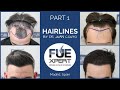 HAIRLINES by Dr Juan Couto at FUExpert Clinic - Hair Transplant Clinic in Madrid, Spain - PART 1