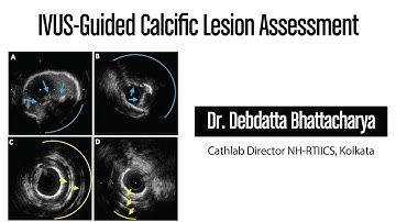 IVUS-Guided Calcific Lesion Assessment