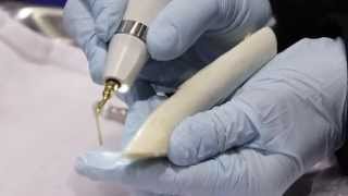 How Piezosurgery® is Changing Bone Surgery in Dentistry(Kim Novak of Piezosurgery Incorporated explains how Piezosurgery is changing dental bone surgery