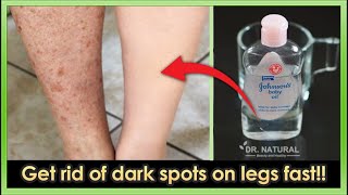 How To Get Rid Of Dark Spots Scar Mosquito Bites Hyperpigmentation On Legs Fast Youtube