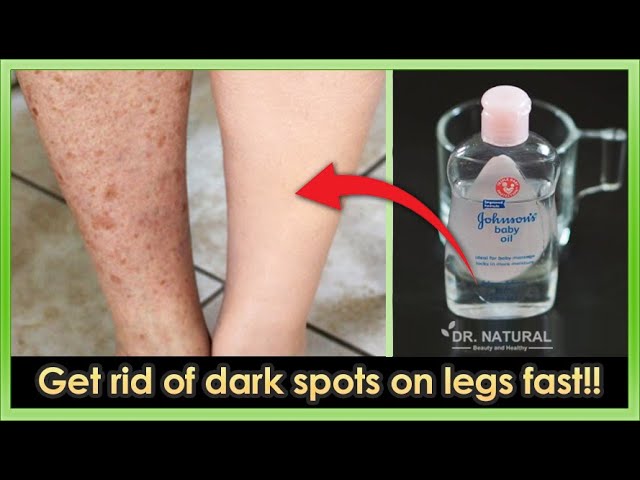How to get rid of Dark spots, Scar, Mosquito Bites
