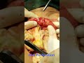 # Terminal Ileal Perforation secondary to untreated typhoid, repaired successfully.