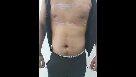 Gynecomastia 1st Post Op Day by Dr. AMit Gupta - Divine Cosmetic Surgery - April 2021